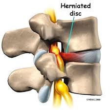 Slipped disc pressing on nerve causing sciatica pain