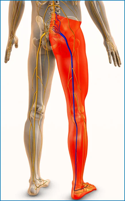 Illustration of sciatica pain traveling down the leg