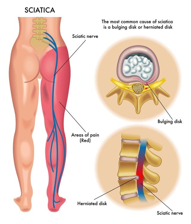 Sciatic nerve anatomy diagram showing nerve path from spine to leg